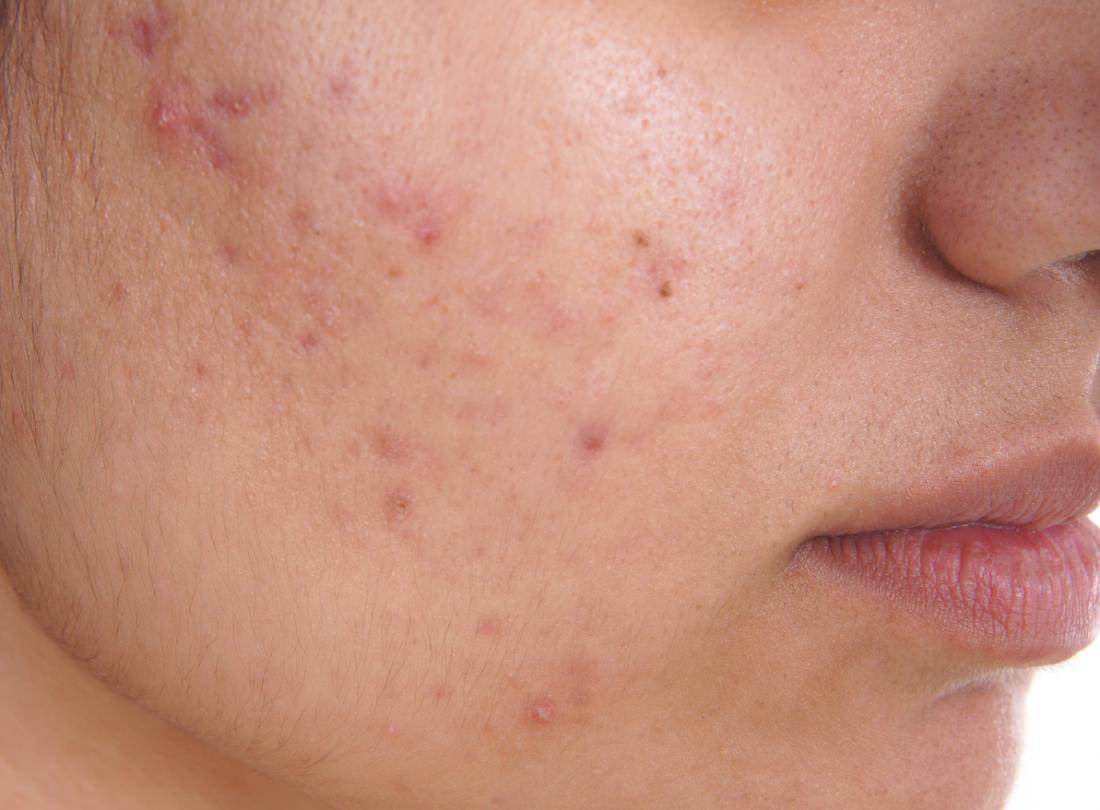 Laser Acne Treatment