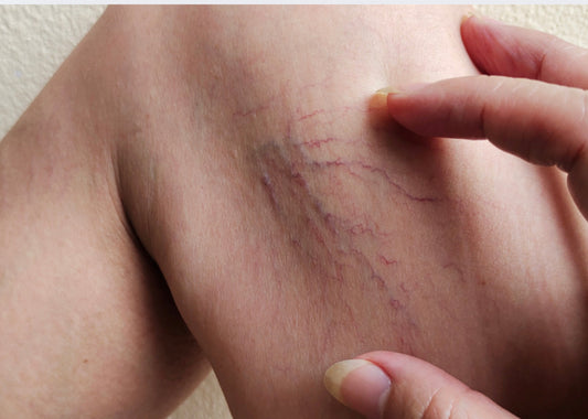 Sclerotherapy