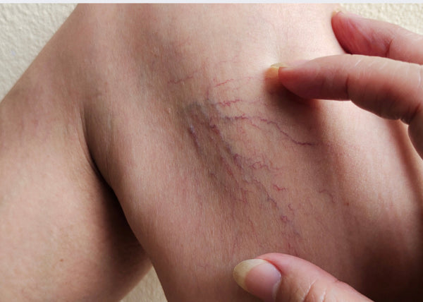 Varicose & Spider Veins