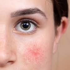 Laser Rosacea Treatment