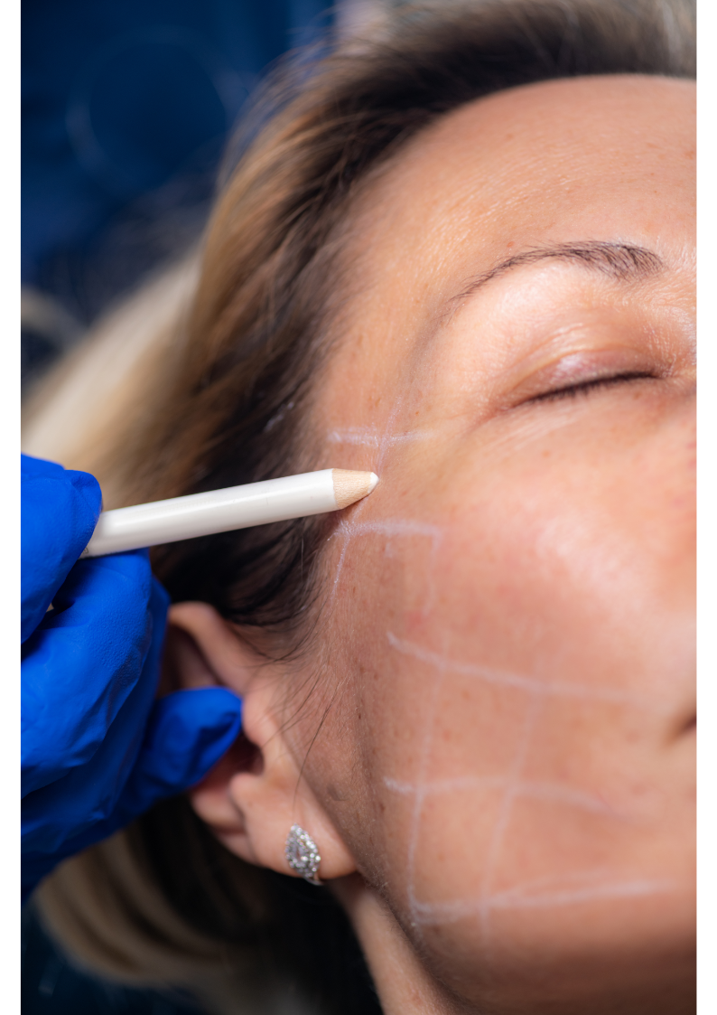 Threading Face Lift Instruments Thread Face Lift – Touch laser medical spa