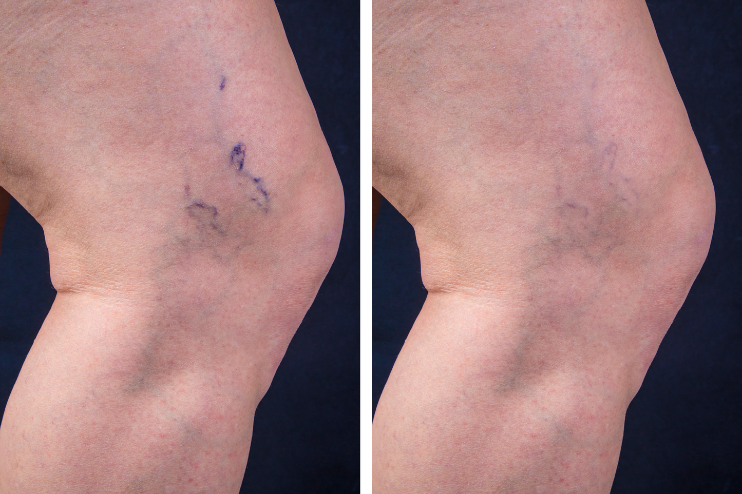 Laser Varicose Veins Removal